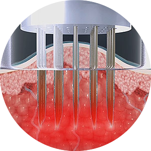 고주파 에너지 발생